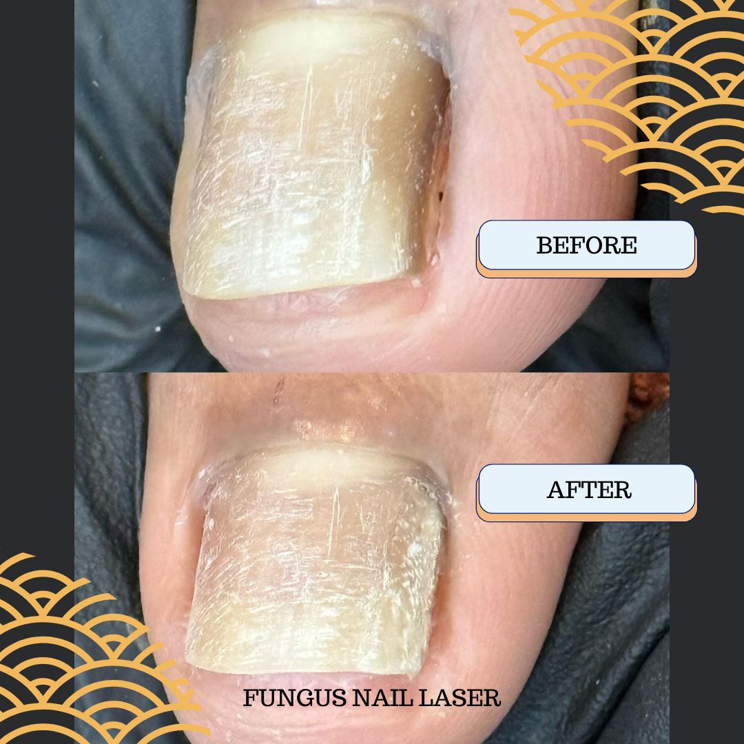 FUNGUS NAIL LASER FUNGUS NAIL LASER